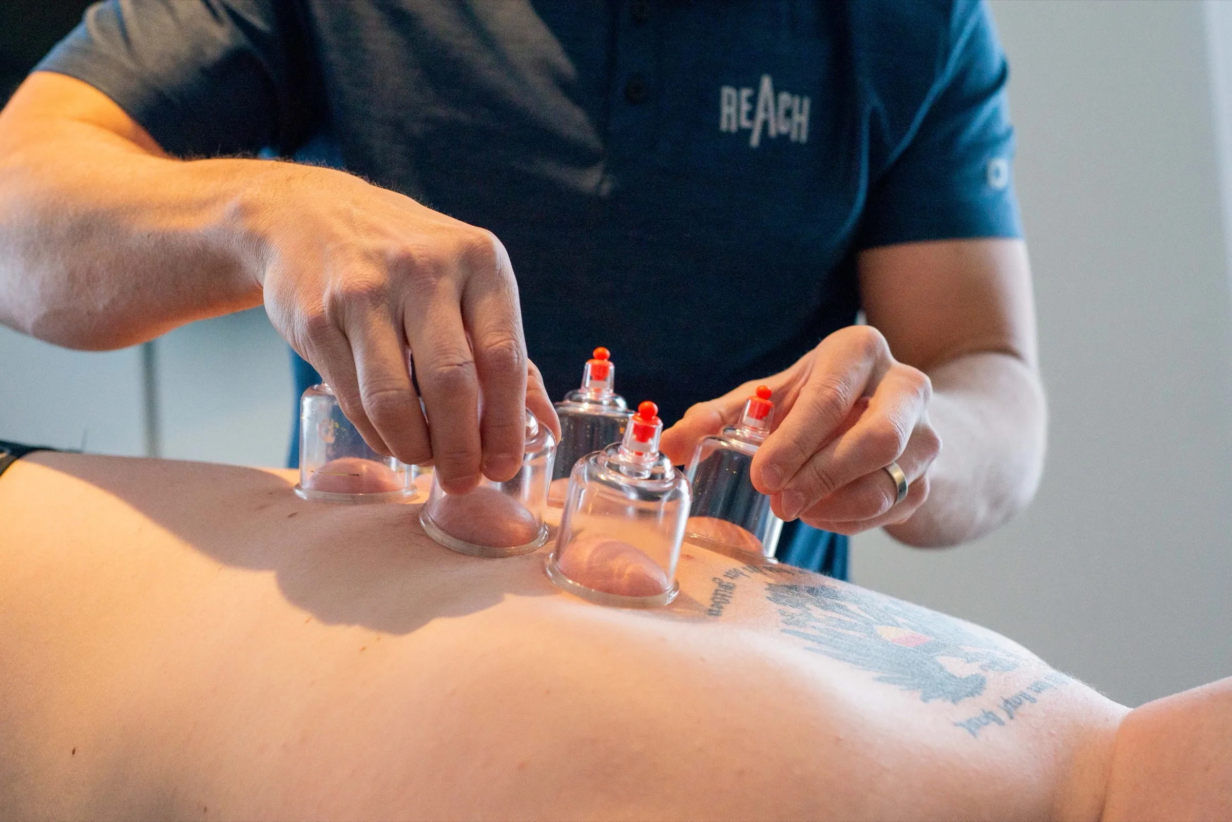 Dr. RJ Burr placing four clear plastic cupping cups with pump-release valves along a patient's lower back at REACH Rehab + Chiropractic in Plymouth, MI
