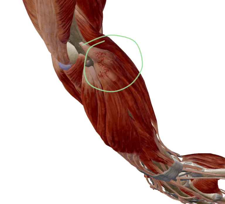 Forearm anatomy render with a green circle marking microtrauma where the extensor tendons attach at the lateral epicondyle, the outer point of the elbow that hurts in tennis elbow