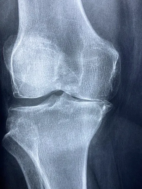 Arthritis – Why It Hurts to Move Your Joints