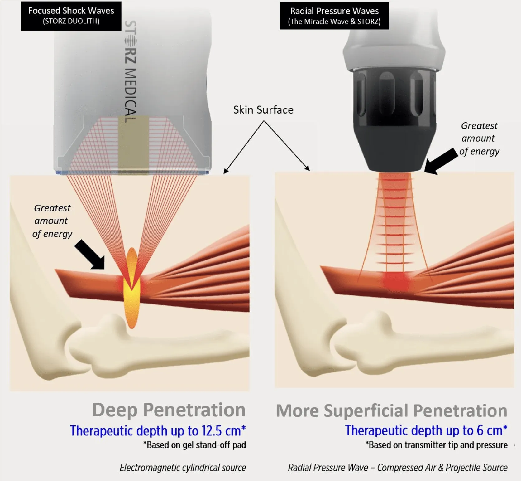 Diagram comparing focused shockwave and radial pressure wave penetration depth into tissue