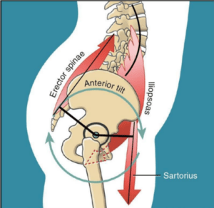 Muscles pulling causing hip impingement from anterior pelvic tilt