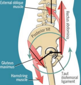 Image showing muscles pull causing hip impingement from posterior pelvic tilt