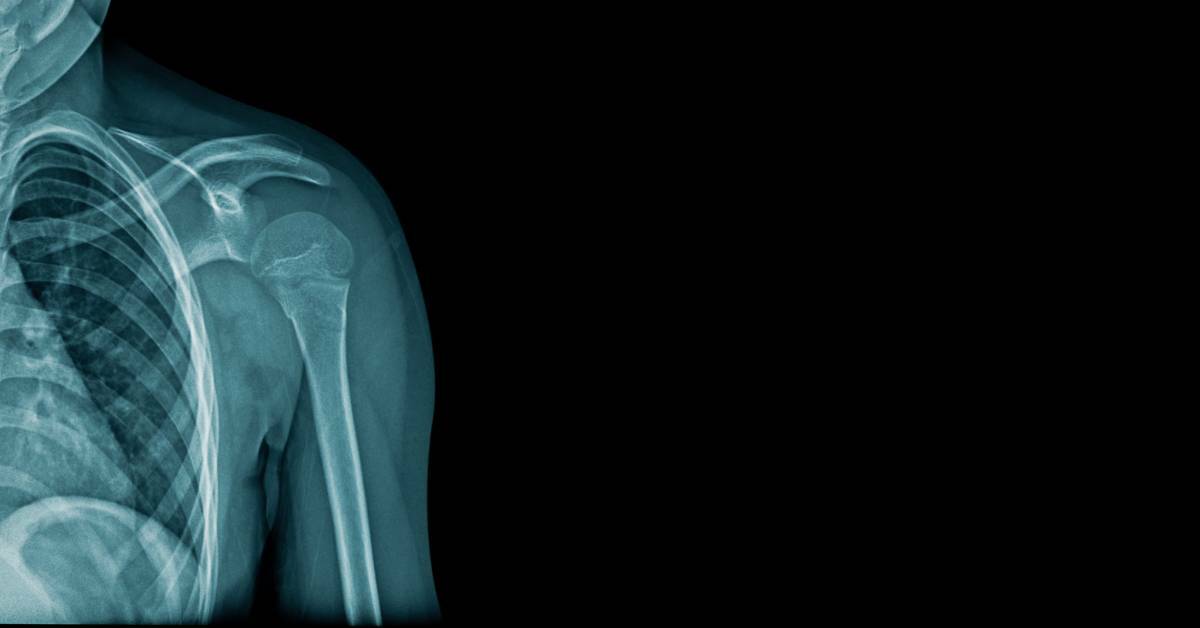 X-ray of a Shoulder | No X-Ray Today? Here's Why We're Holding Off | REACH Rehab + Chiropractic